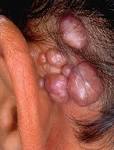 <b>Angiolymphoid hyperplasia</b> with <b>eosinophilia</b>: A study of 7 cases