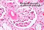 malignant <b>nephrosclerosis</b>
