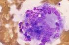 Datei:Multinucleate giant cell in subacute thyroiditis.jpg – Wikipedia
