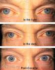 Physiologic <b>anisocoria</b>. EyeRounds.org: Online Ophthalmic Atlas