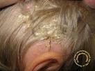 DERMATOLOGIE fausse <b>teigne</b> amiantacée tinea amiantacea pityriasis
