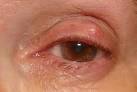 bump in the <b>eyelid</b>.