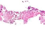 File:<b>Amebiasis</b> - very high
