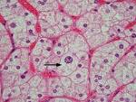 CT and MR Imaging of the <b>Adrenal</b> Glands in ACTH-independent