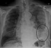 <b>Mesothelioma</b> - Wikipedia