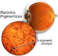 <b>Retinitis Pigmentosa</b>
