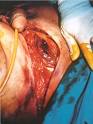 Miositis (inflamación <b>del</b>