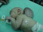 Los <b>encefaloceles</b> parietales