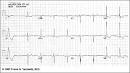 <b>Right Ventricular Hypertrophy</b>