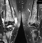 <b>Erdheim</b>-<b>Chester Disease</b>: