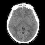 <b>Subdural empyema</b>