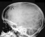 <b>Sinus pericranii</b>.