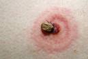 Lyme Disease Bull's Eye rash