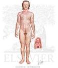 of <b>Hyperandrogenism</b>