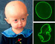 <b>Progeria</b>