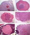 Pancreas – <b>islet cell adenoma</b>.