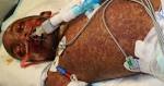 What are Symptoms & Treatment of <b>Stevens Johnson Syndrome</b>?