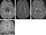 Infantile <b>Refsum Disease</b>: Case