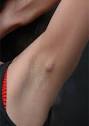 Lump in Armpit | Lump Under Armpit | Armpit Lump | Painful Lump in ...