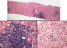 <b>Chronic hepatitis C</b> infection