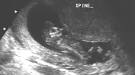 Ultrasound Section Featured Article: Exencephaly-ANENCEPHALY Sequence