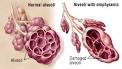 <b>Emphysema</b> and chronic