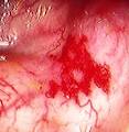 of <b>angiodysplasia</b> courtesy