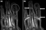 File:<b>Psoriatic arthritis</b>