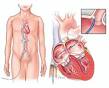 Evolution of <b>Catheter Ablation</b>
