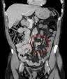 demonstrating a <b>volvulus</b>