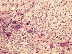 <b>Tumor</b> de <b>células gigantes</b>
