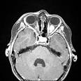 shaped <b>optic nerve tumor</b>.