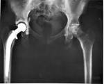 File:<b>Hip replacement</b> Image