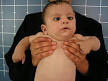 <b>Möbius syndrome</b>