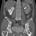 <b>Renal tuberculosis</b> - “<b>Renal</b>