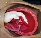 <b>Retained Placenta</b>