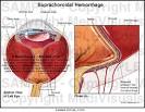 Medivisuals Suprachoroidal <b>Hemorrhage</b> Medical Illustration