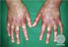 <b>Rothmund</b>-<b>Thomson Syndrome</b>