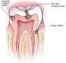 Image result for ‫پوسيدگي دندان1‬‎