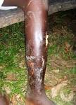 <b>Osteomyelitis</b>
