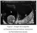 <b>transfusión feto</b> – <b>fetal</b>,