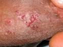 <b>Doenca Genital</b>