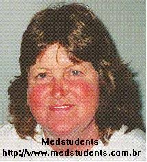 Butterfly Rash in Lupus MAGES-