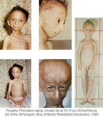 Month Archives - Progeria