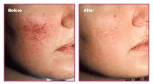 irvine dermatology sclerotherapy for veins