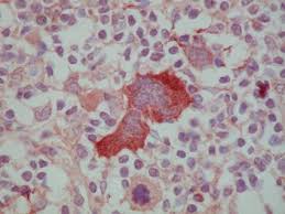 Hodgkins lymphoma cell
