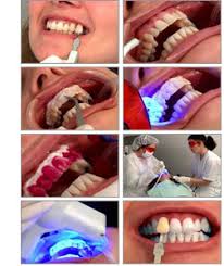 dientes ¿En qué consiste un tratamiento de blanqueamiento dental?