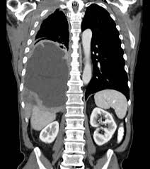 CT scan / Mesothelioma Tumor