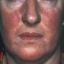 acne rosacea image