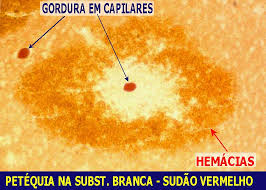 Cerebral fat embolism